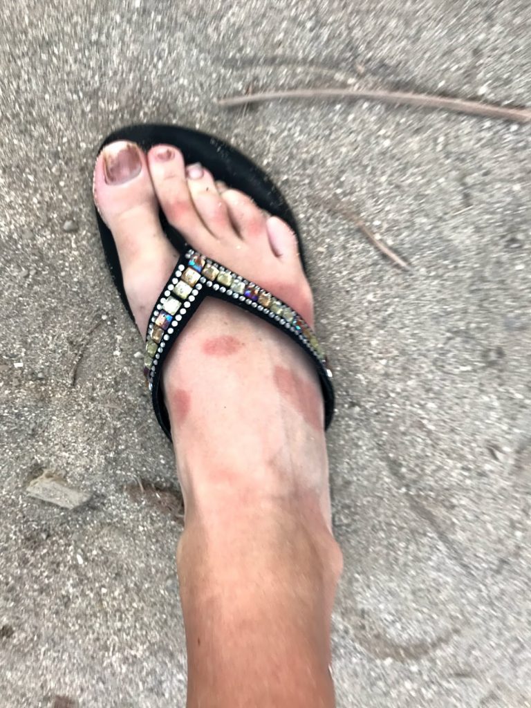 Sunburned foot